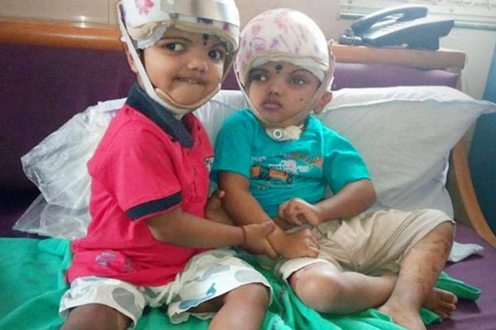Surgery to separate 28-month-old Jagga and Kalia recorded in Limca Book