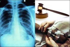 Chemotherapy given 3 times by giving TB patient cancer