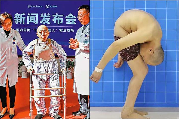 China man who was folded in half for past 28 years