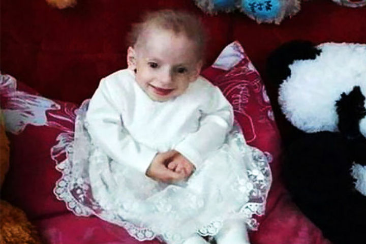 8-year-old girl died of disease called  progeria