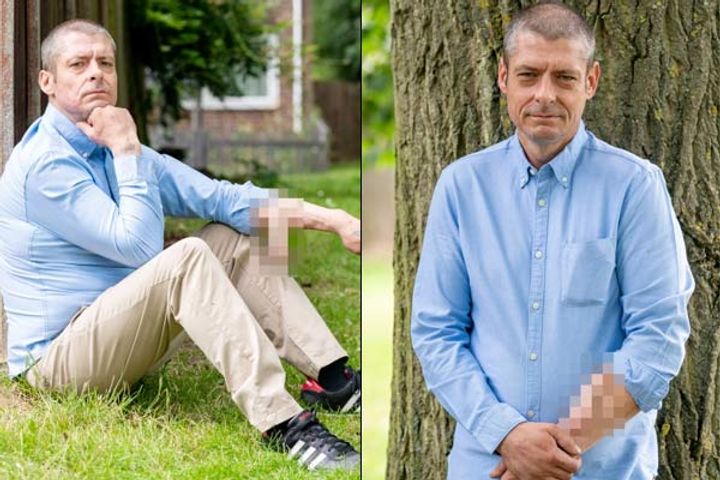 Man who lost penis due to blood infection has new one built on his arm