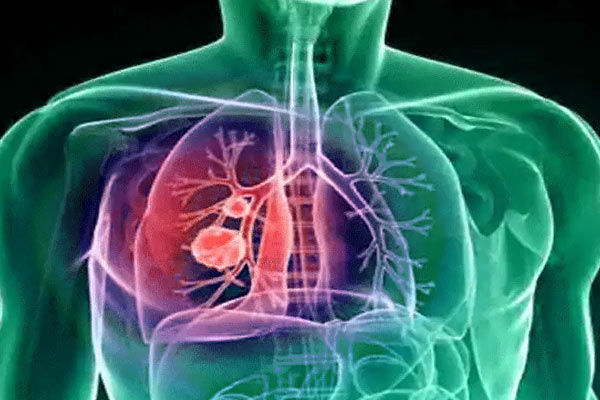 Vaccines against respiratory infections linked with less heart failure deaths 