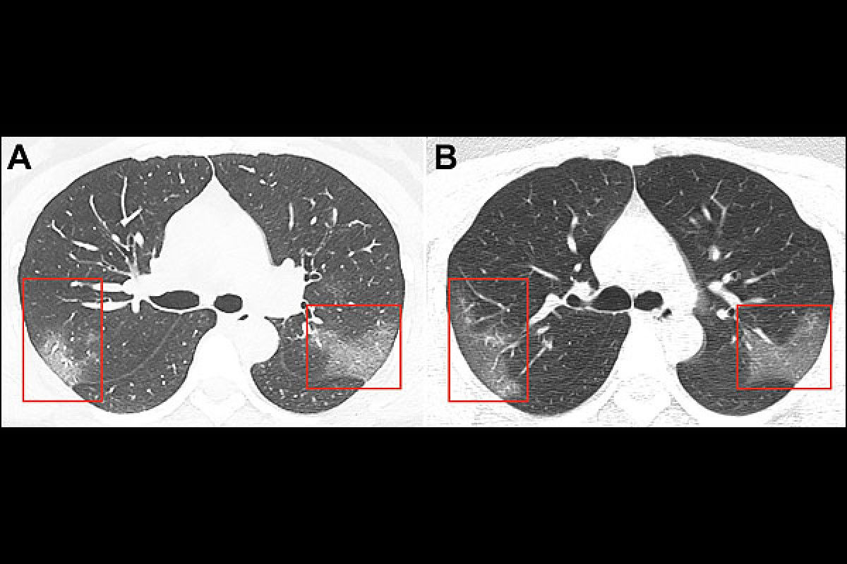 Как выглядят легкие после ковид Chinese doctors release chest X-rays of Coronavirus patient - Shortpedia News Ap