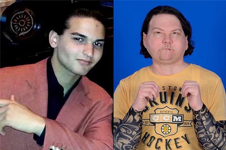 First man to undergo face transplant First man to undergo face transplant