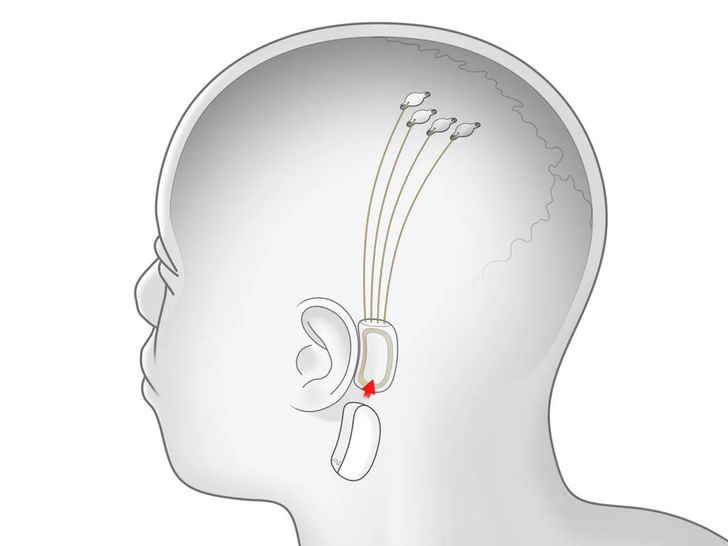 Neuralink’s Brain Chip Is Envisioned to Cure Anything Neuralink’s Brain Chip Is Envisioned to Cure Anything