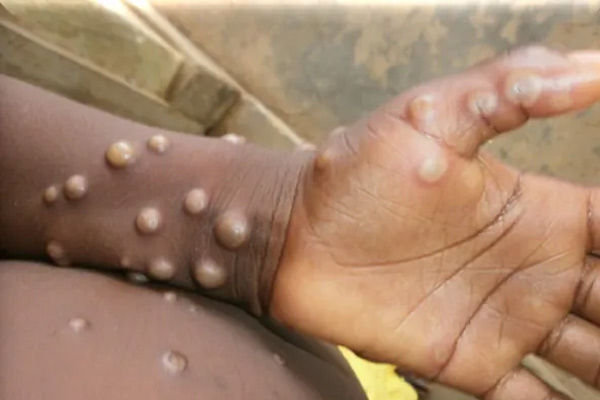 first case of monkeypox detected in Texas