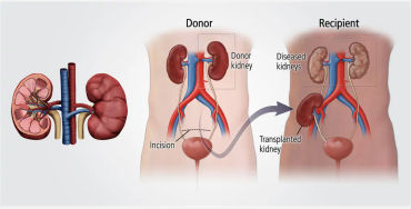 kidney, kidney transplant, kidney facts, kidney fact, three kidneys, 3 kidneys
