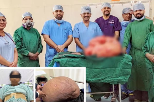 Doctors removed 47 kg tumor from woman stomach