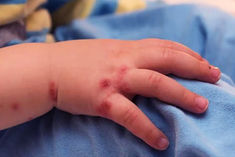 tomato flu in kerala