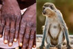the first patient of monkeypox surfaced in america many patients were also found in spain portugal a