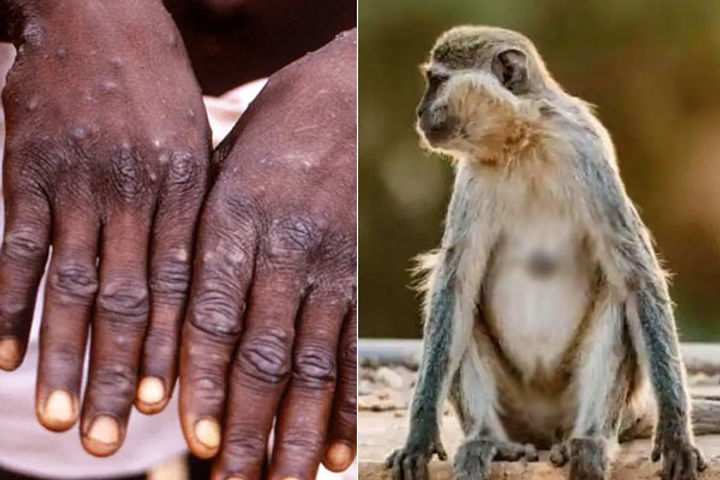 the first patient of monkeypox surfaced in america many patients were also found in spain portugal a