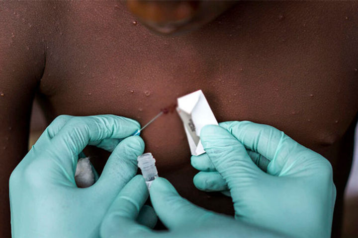 Monkeypox virus spread in 15 countries in 15 days