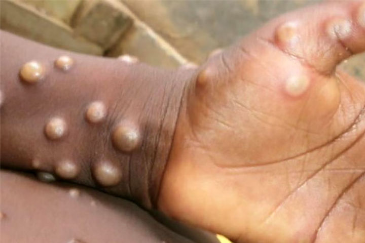 Who Says 780 Cases Of Monkeypox Reported Or Identified