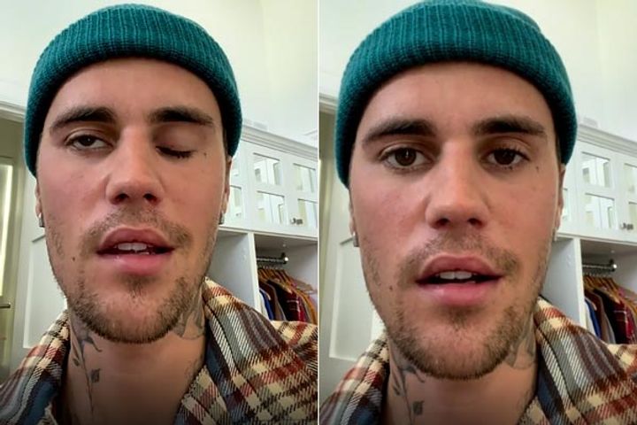 half of justin biebers face paralyzed half of justin biebers face paralyzed