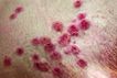 Death in Nigeria due to monkeypox, there are 3,413 cases worldwide