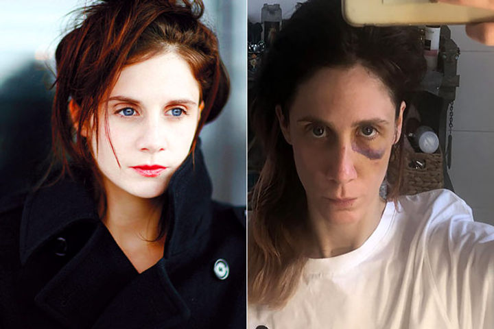 french actress judith chemla shares horrific photos of injuries stemming from domestic abuse