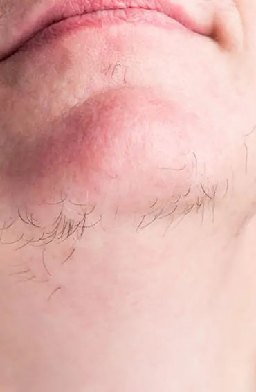 pcos, pcos symptoms, pcos meaning, pcos treatment, pcos diet, metformin for pcos, how to cure pcos p