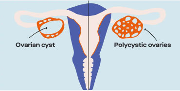 pcos, pcos symptoms, pcos meaning, pcos treatment, pcos diet, metformin for pcos, how to cure pcos p