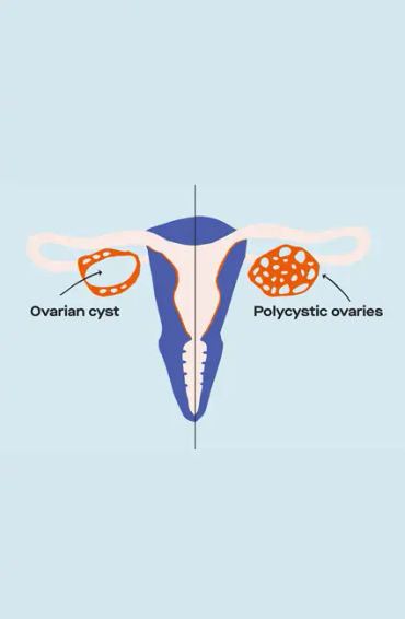 pcos, pcos symptoms, pcos meaning, pcos treatment, pcos diet, metformin for pcos, how to cure pcos p