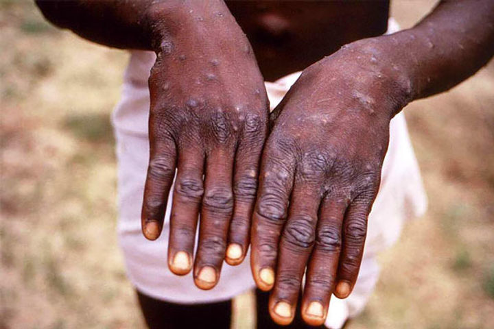 person who returned from uae to kerala is suffering from monkeypox 