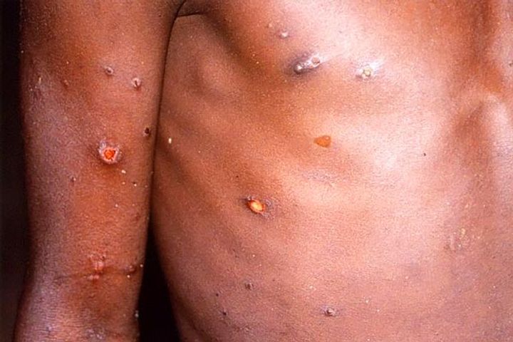 second case of monkeypox found in kerala second case of monkeypox found in kerala