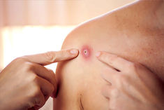 Study revealed, monkeypox spreading more due to sexual activities