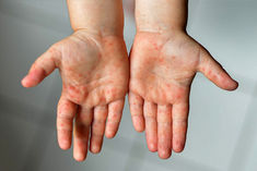 mexico confirms 60 cases of monkeypox