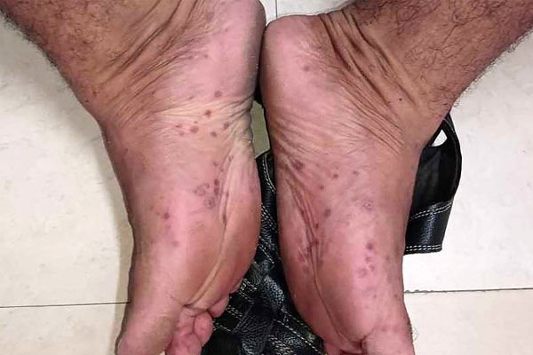 suspected monkeypox patient who came to karnataka from ethiopia turned out to be suffering from chic