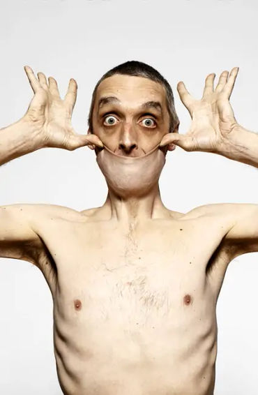 world record, stretchy skin, brit garry, collagen, ehlers danlos