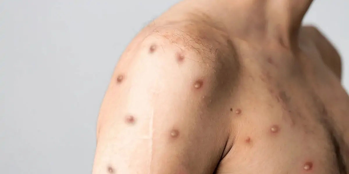 Monkeypox