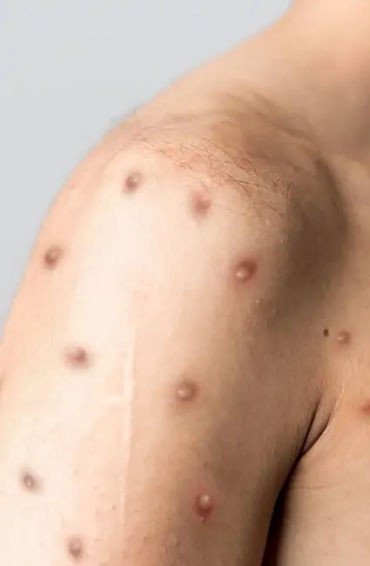 Monkeypox