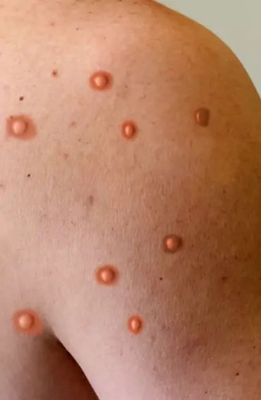  monkeypox