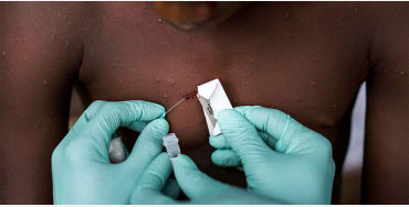monkeypox, disease, africa, infected, cases