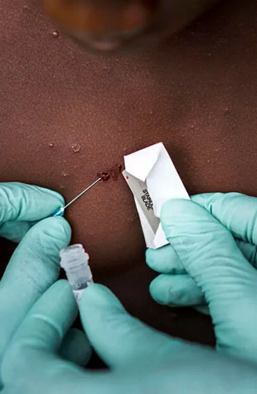 monkeypox, disease, africa, infected, cases