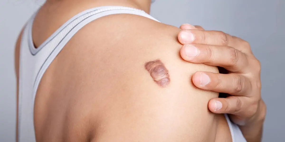 monkeypox, disease, africa, infected, cases