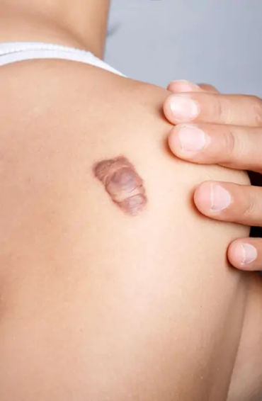 monkeypox, disease, africa, infected, cases