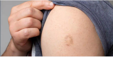monkeypox