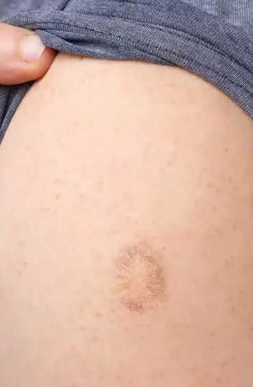 monkeypox