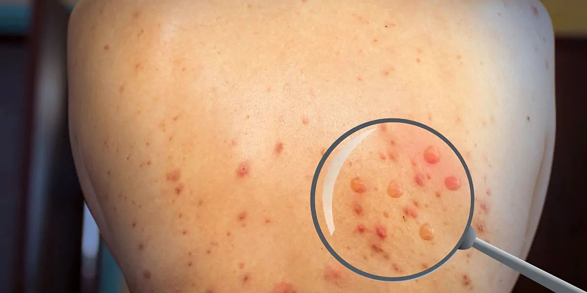 Monkeypox, disease, africa, infected, cases