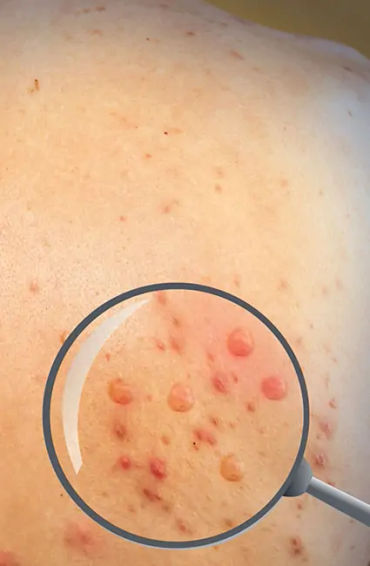 Monkeypox, disease, africa, infected, cases