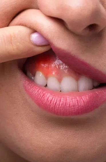 gum disease