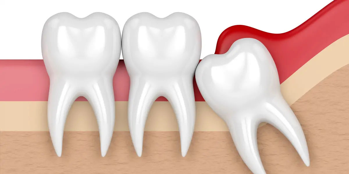 wisdom tooth, gums, teeth, painful, extra teeth, genetics