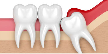 wisdom tooth, gums, teeth, painful, extra teeth, genetics