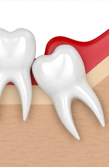 wisdom tooth, gums, teeth, painful, extra teeth, genetics