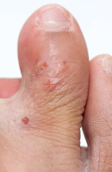 Eczema 