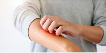 Eczema