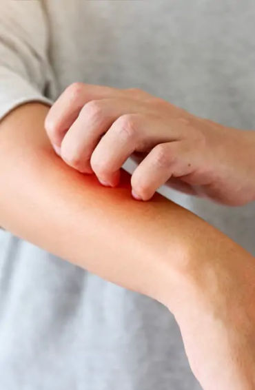 Eczema