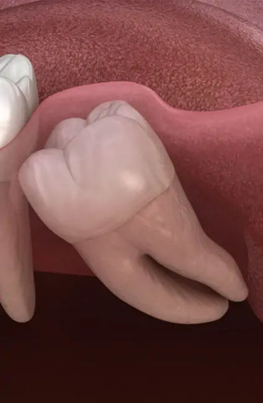  tooth
