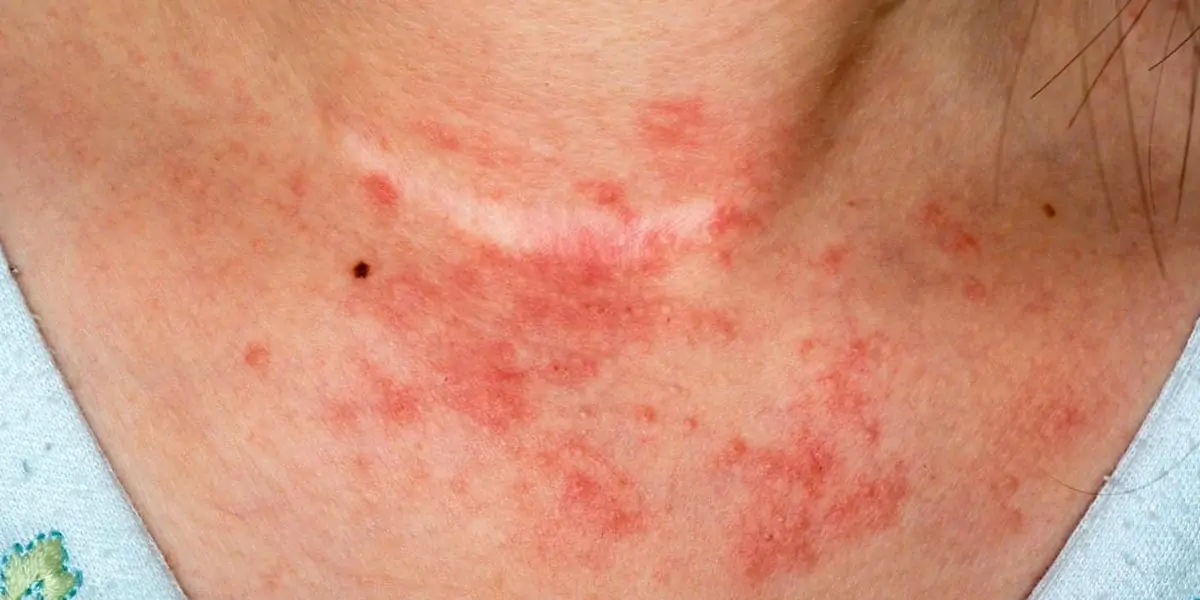 Eczema
