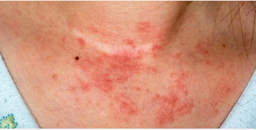 Eczema